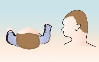 短頭症、頭頂部が突出