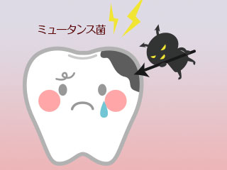 歯を攻撃するミュータンス菌