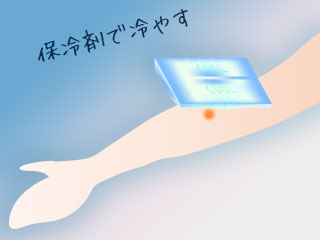 保冷剤で虫さされを冷やす