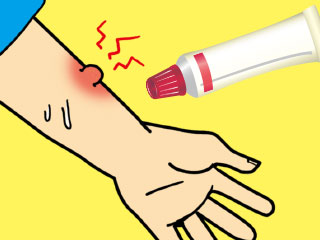 虫刺されと市販の塗り薬