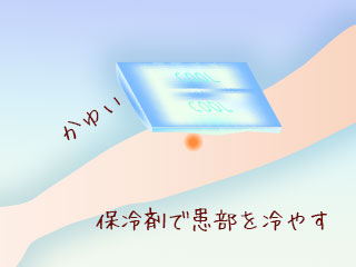 保冷剤で虫刺されを冷やす