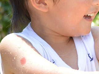 腕に赤い虫刺されがある子供