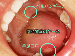 舌と喉に発疹が出来ている同時発症のケース