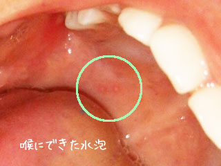 喉にできた水泡