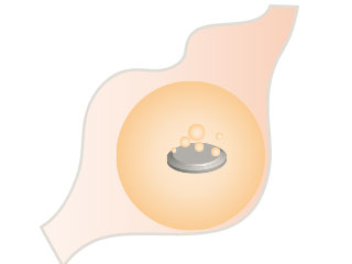 胃の中で溶けるボタン電池