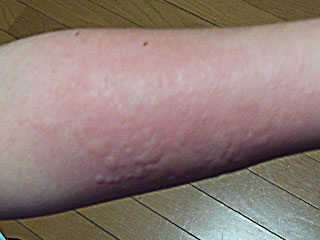 蕁麻疹の出た腕