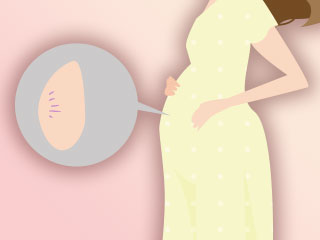 お腹の妊娠線