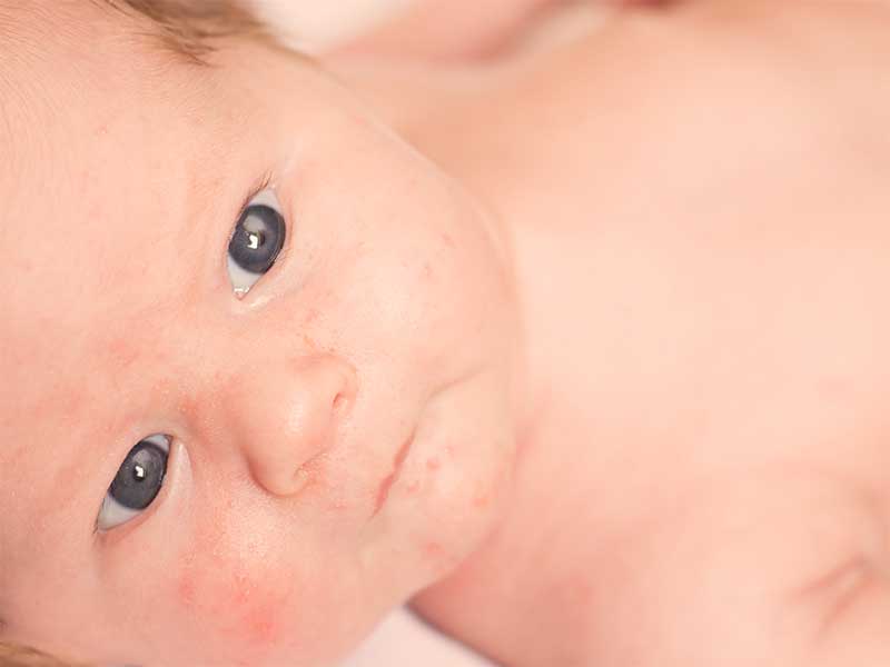 ほっぺに赤いニキビができてる新生児