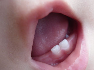 下の前歯の乳歯