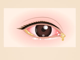 結膜炎の症状