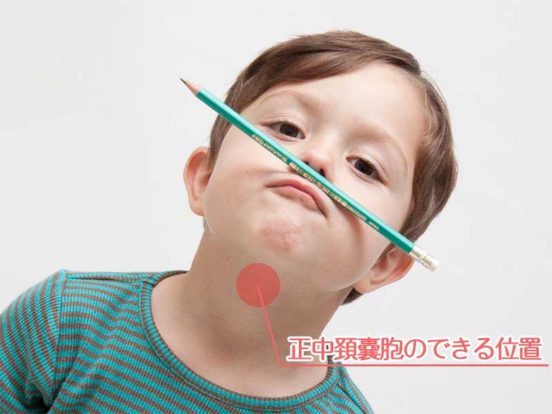 正中頚嚢胞ができる首の位置