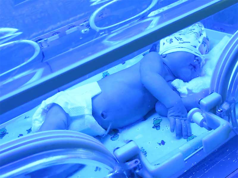 光線治療を受けている新生児