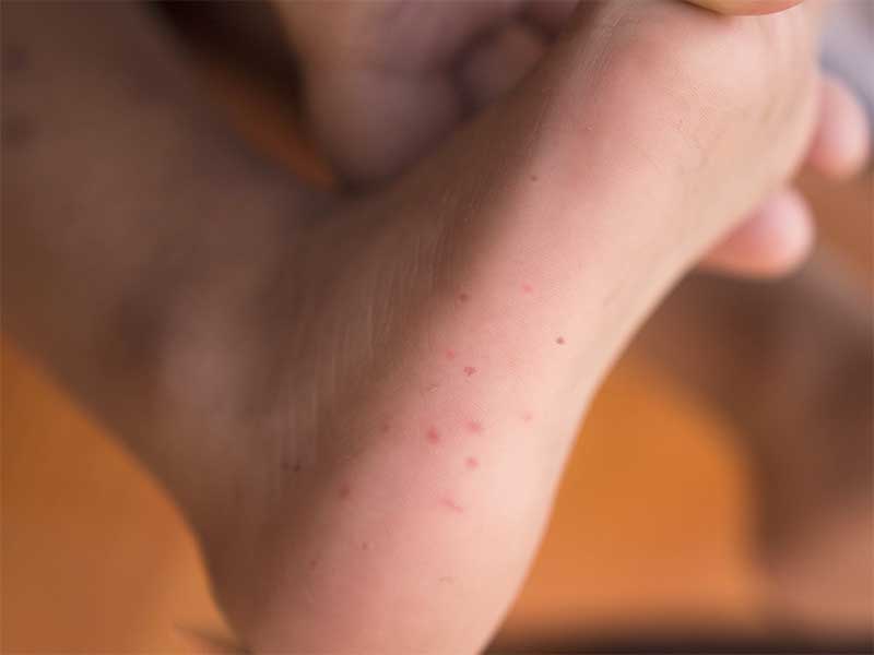 手足口病で湿疹が出ている子供の足