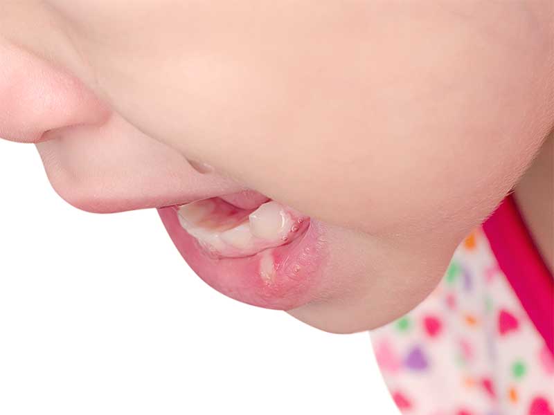 下唇に口内炎ができいる子供
