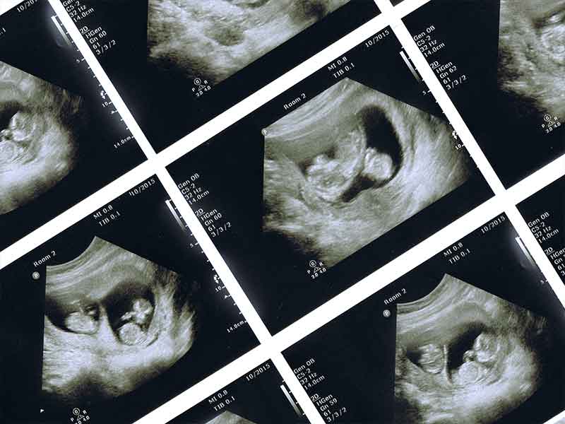 胎児が写っているエコー写真