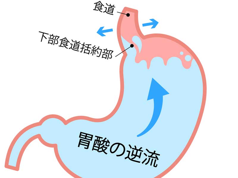 胃酸が逆流している胃のイラスト