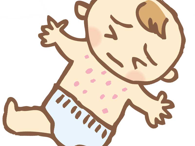 アレルギー症状の湿疹が出ている子供のイラスト