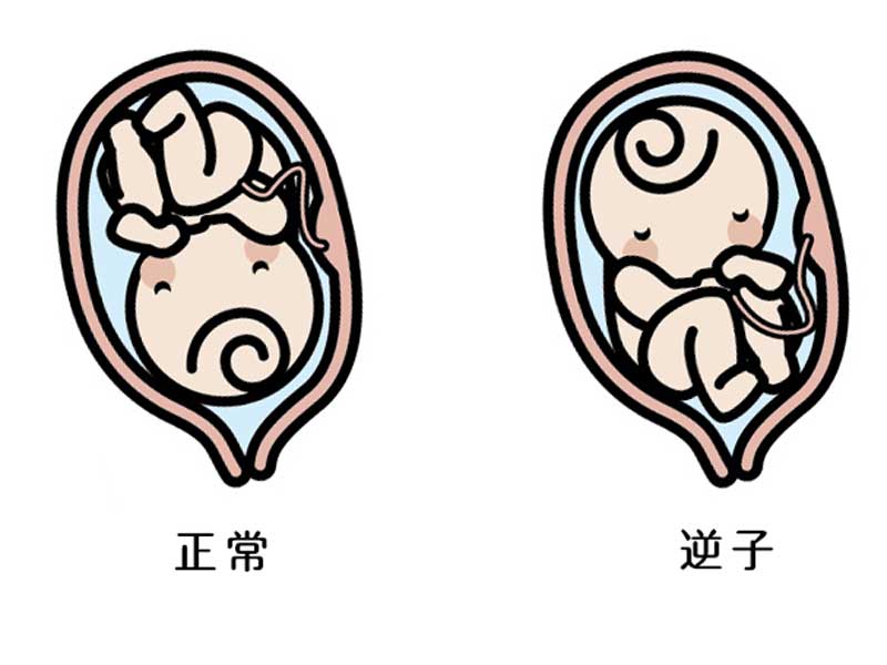 逆子の説明のイラスト