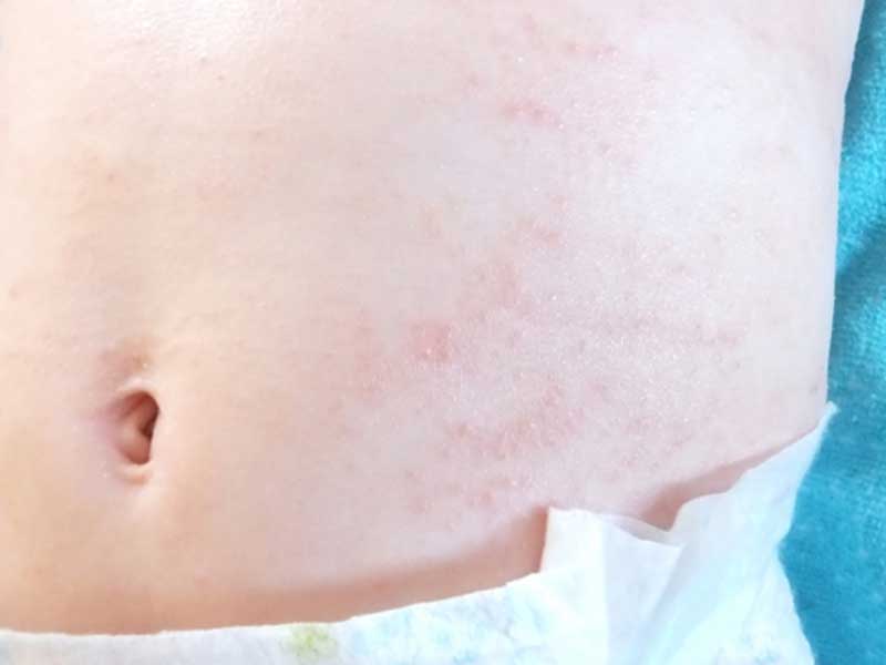 お腹に湿疹が出ている赤ちゃん