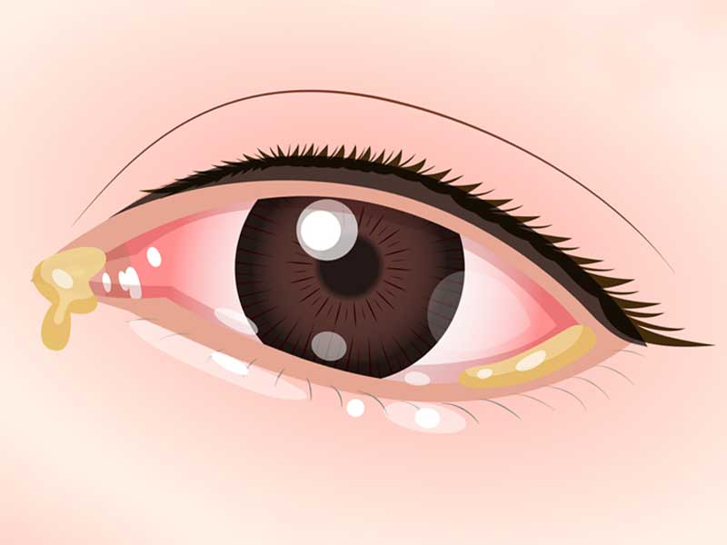 結膜炎の目のイラスト