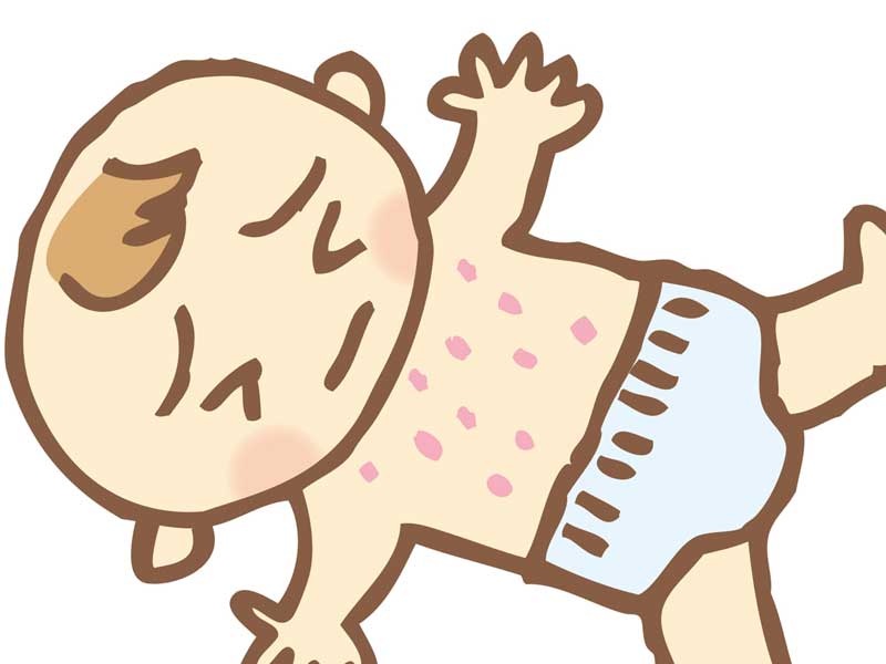 アトピー性皮膚炎の赤ちゃんのイラスト