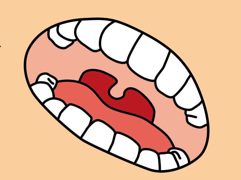 歯並びのイラスト