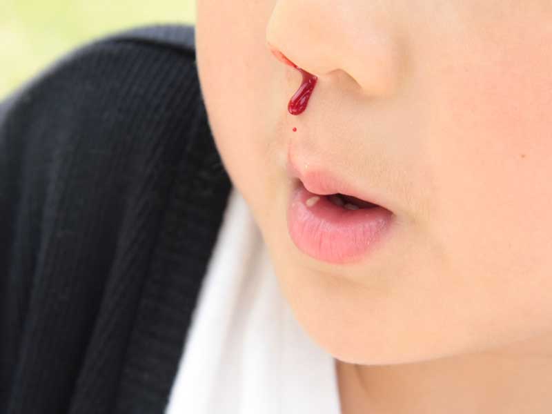鼻血が出ている男の子