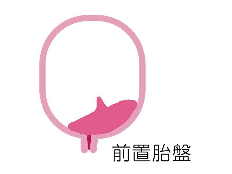 前置胎盤のイラスト