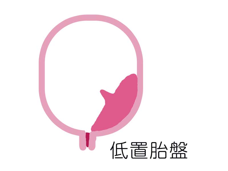低置胎盤のイラスト