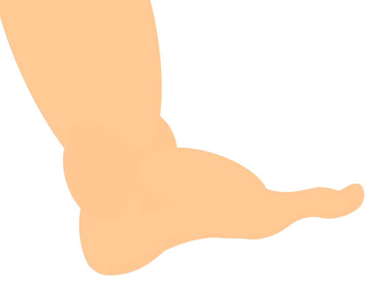 浮腫んでいる足のイラスト