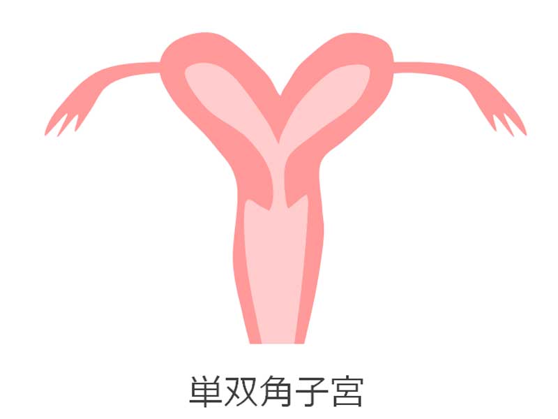 単頚双角子宮のイラスト