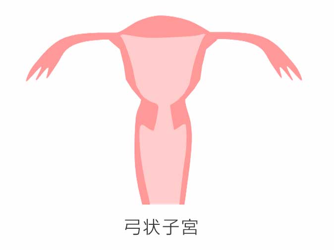 弓状子宮のイラスト