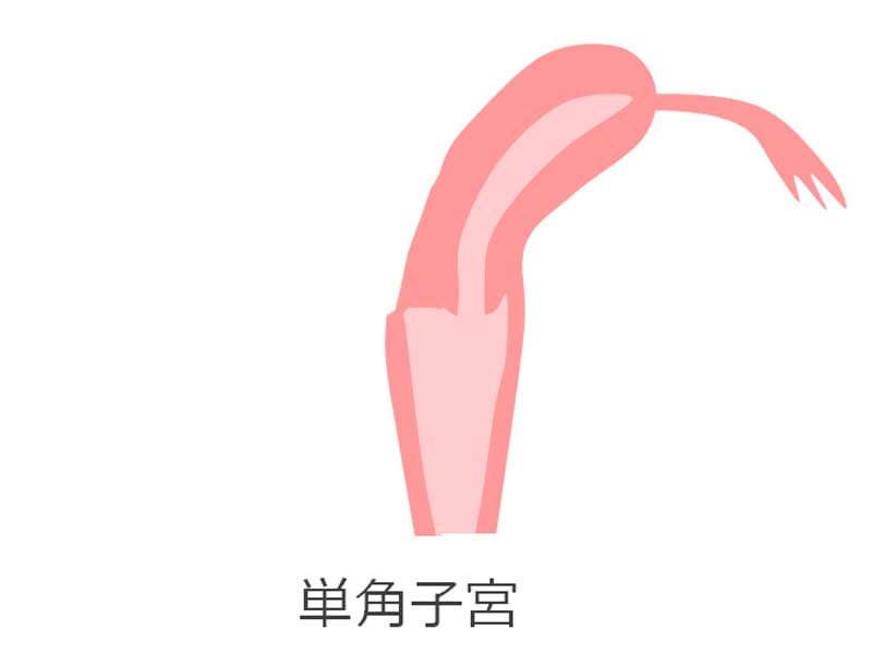 単角子宮のイラスト