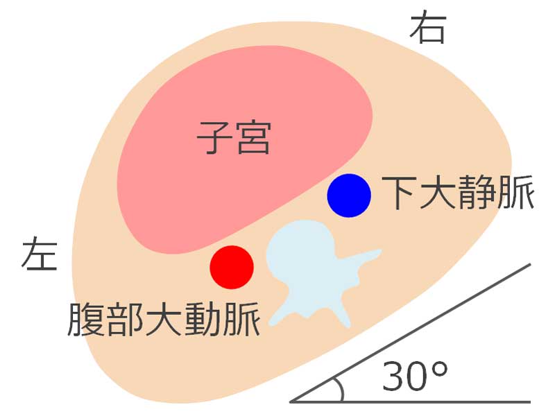 仰臥位低血圧症候群を防ぐ寝方のイラスト