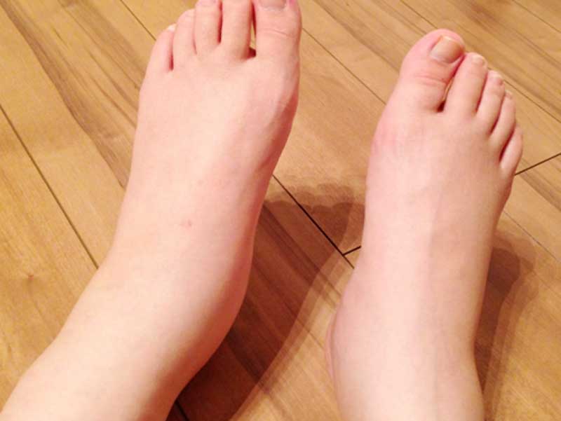 浮腫んでいる妊婦さんの足