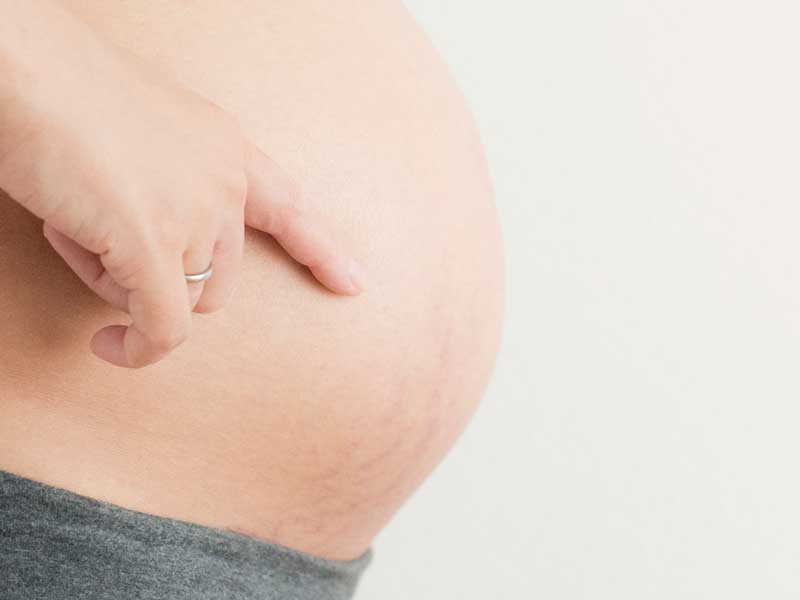 妊婦さんのお腹の妊娠線