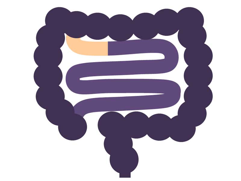 ヒルシュスプルング病の広範囲型のイラスト