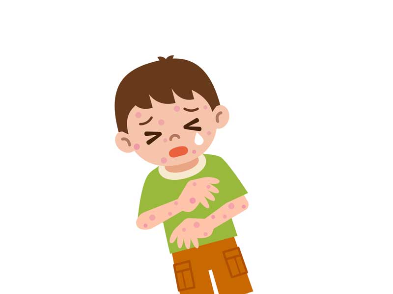アレルギーで発疹が出ている子供のイラスト
