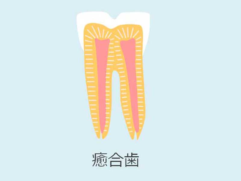 癒合歯のイラスト