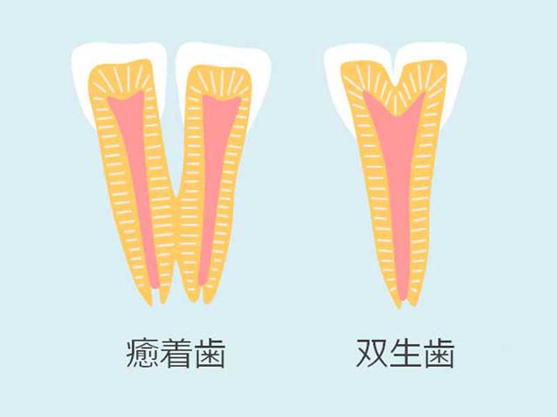 癒着歯と双生歯のイラスト
