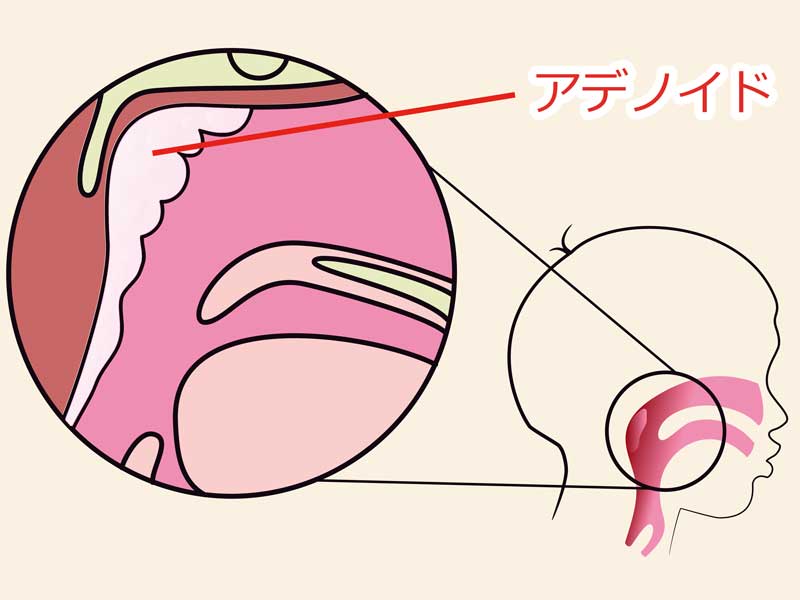 アデノイド部位説明のイラスト
