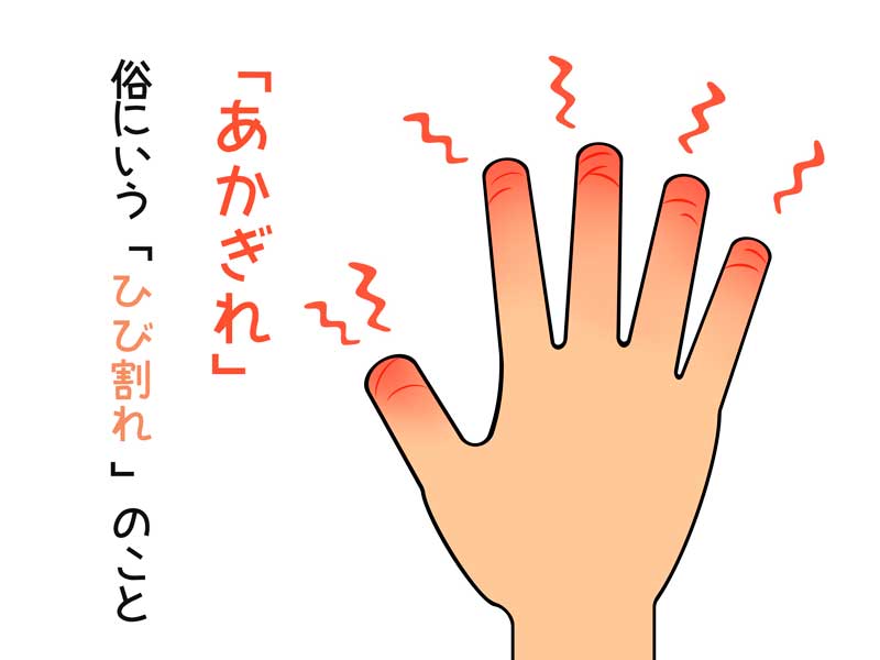 あかぎれのイラスト