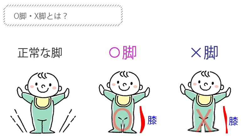 O脚・X脚とは?イラスト