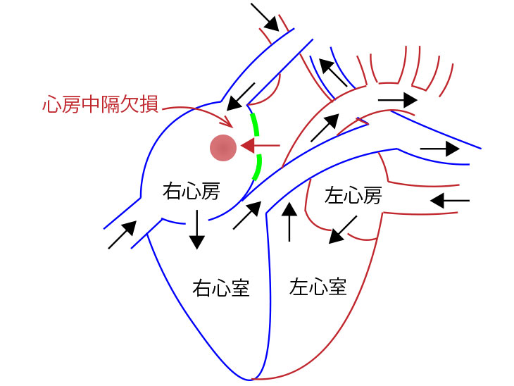 心房中隔欠損症図