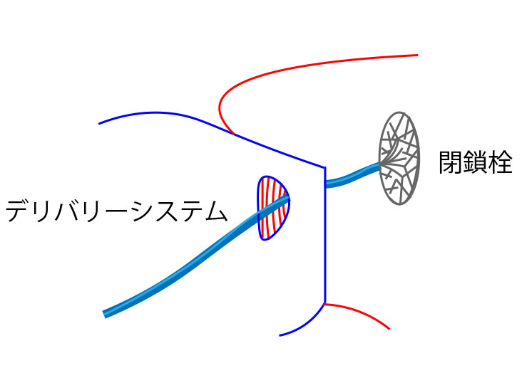 閉鎖栓とデリバリーシステム図