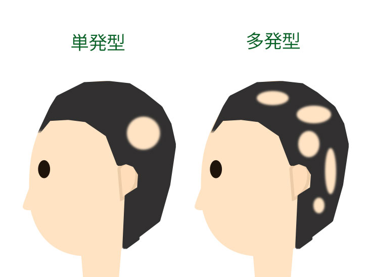 円形脱毛症の単発型と多発型の違いイラスト