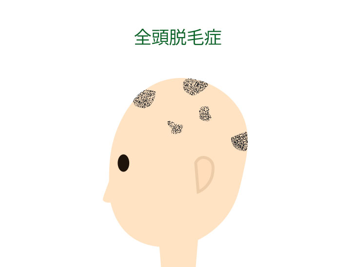 全頭脱毛症イラスト