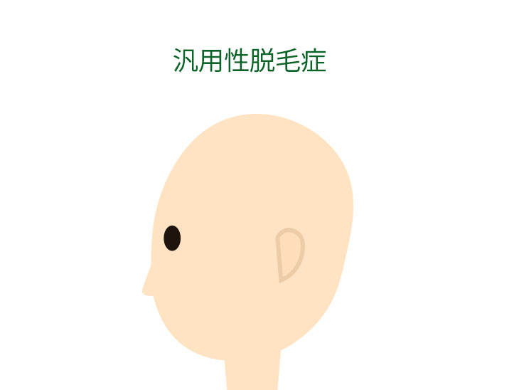 汎用性脱毛症イラスト