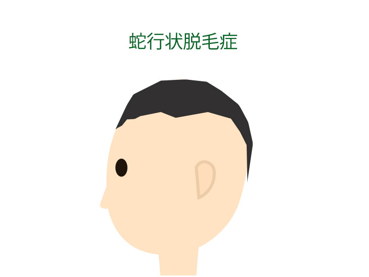 蛇行状脱毛症