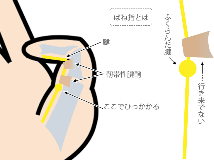 ばね指解説イラスト